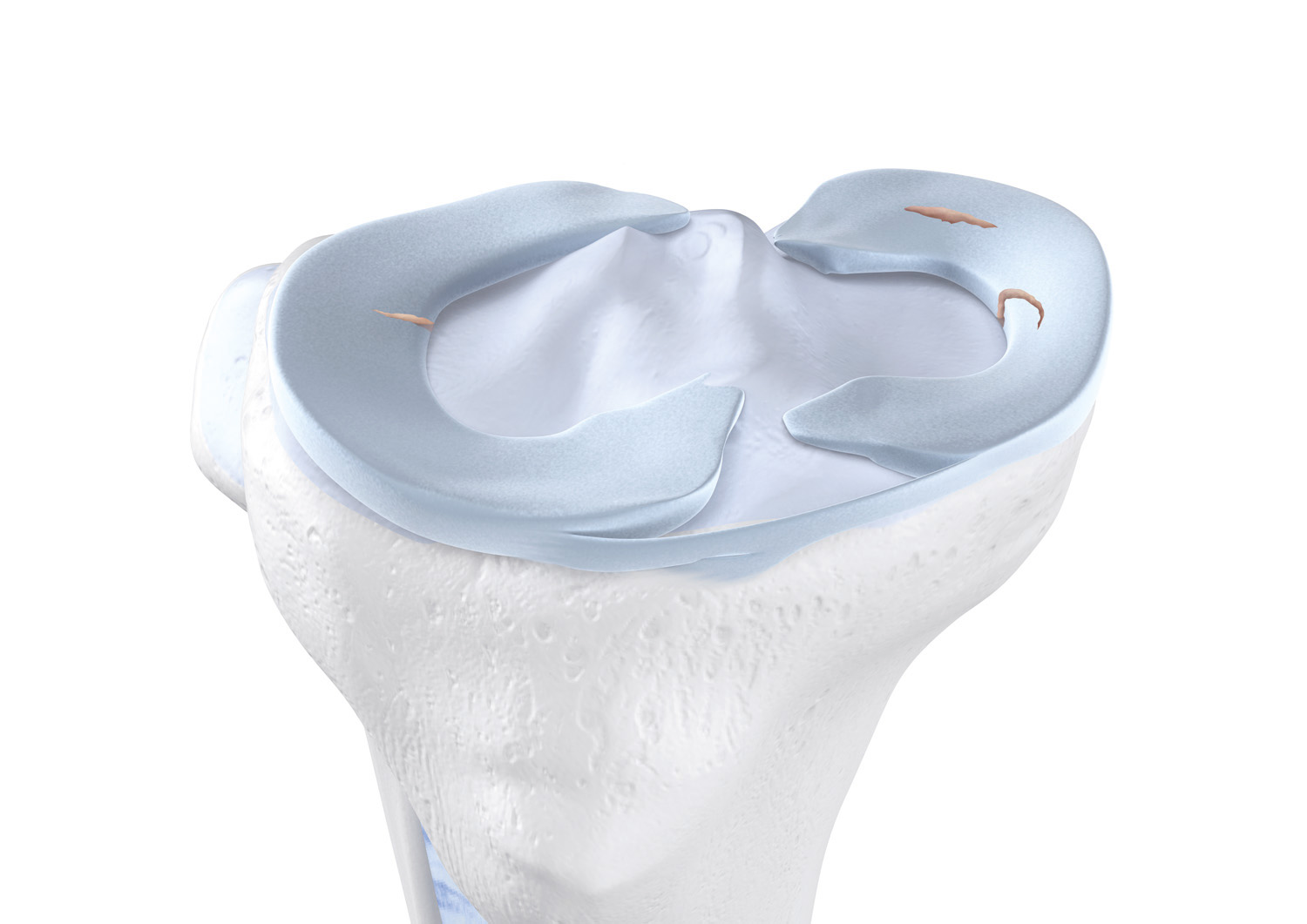 Meniskusriss im Knie Meniskusriss im Knie